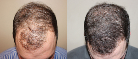 Hair Transplant Riverside CA – Advanced FUE Hair Restoration Inland Empire